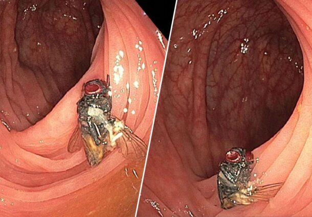 musca, colonoscopie, examen, Missouri